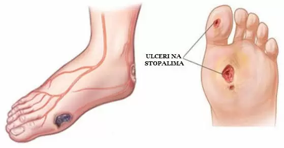 dijabeticno stopalo ulceri na stopalima